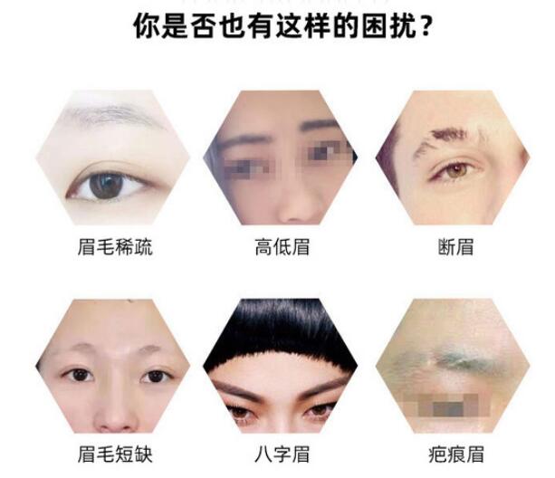 种植眉毛后的果图文讲解护理&优点，“美眉”的正确打开方式！