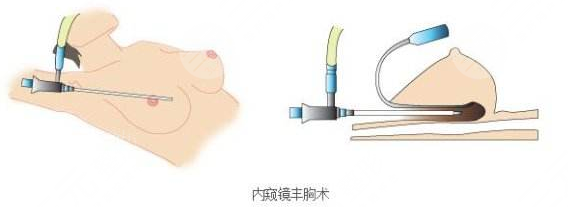 内窥镜隆胸和普通隆胸有什么区别？内窥镜隆胸恢复期要多久？价格表
