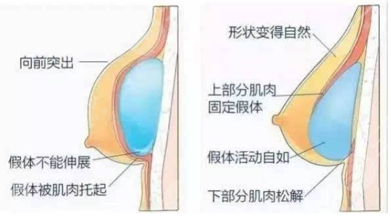 内窥镜隆胸和普通隆胸有什么区别?