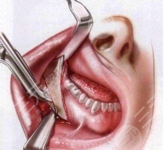 削骨瘦脸风险大吗削骨瘦脸价格是多少