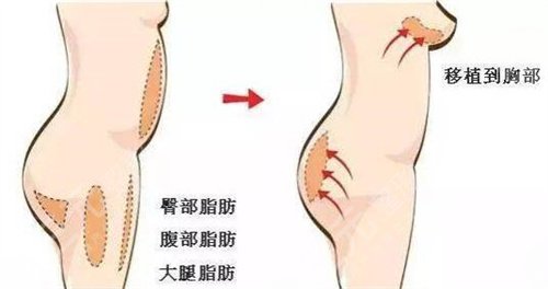 硅胶隆胸取出来会成什么样子