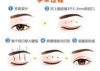 韩式微创双眼皮的原理/过程讲解，美眼小课堂科普！