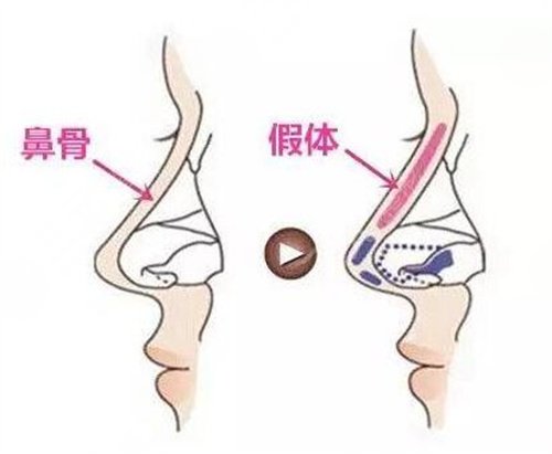  骨粉隆鼻危害