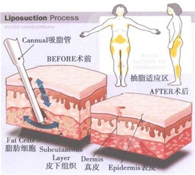 提臀手术怎么做的