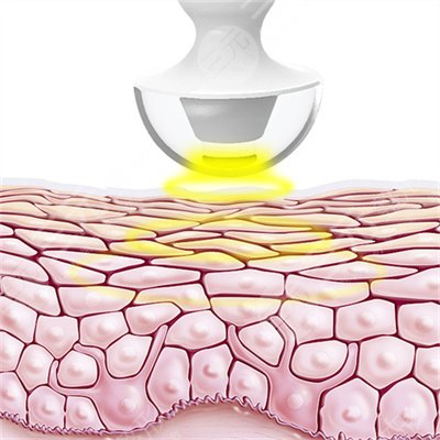 热玛吉做完老得更快是真的吗？热玛吉原理果揭晓！热玛吉果