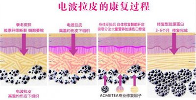 真人拉皮除皱后7周