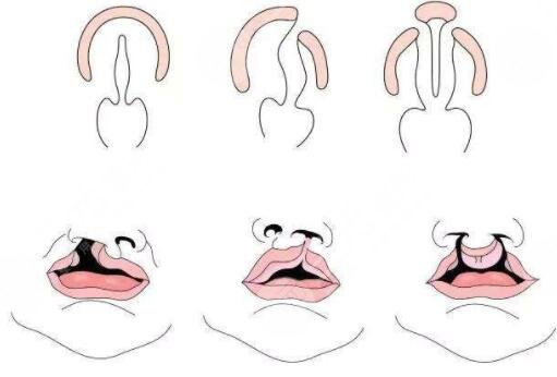 儿童唇腭裂有哪些表现?