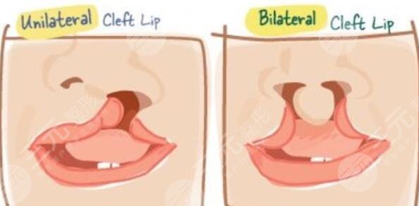 儿童唇腭裂的病因是什么?