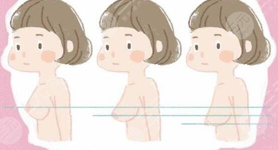 胸部下垂有什么好办法可以提升?胸部下垂怎么上提?get这几种方法