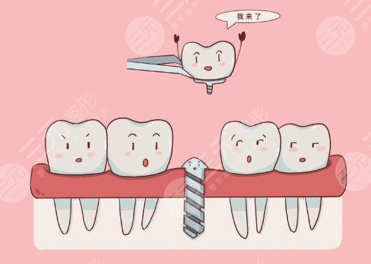 种植牙的原理是什么?