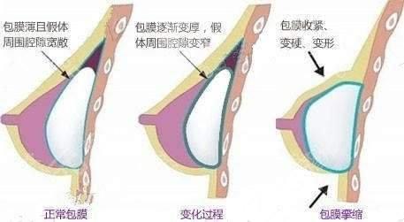 假体隆胸的注意事宜有哪些？