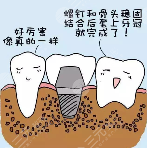 九院种植牙技术介绍：