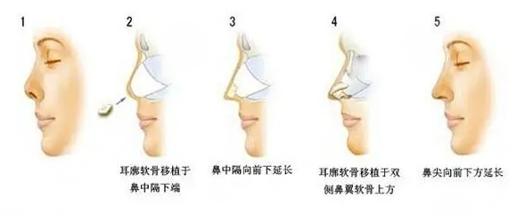 美鼻攻略|耳软骨隆鼻恢复期多久?注意事项+术后护理盘点!