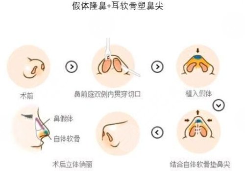 耳软骨隆鼻术前注意事项