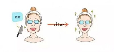 杏林下颌角整形真实案例