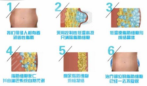 冷冻溶脂瘦腹部减肥前后对比果图片和恢复过程