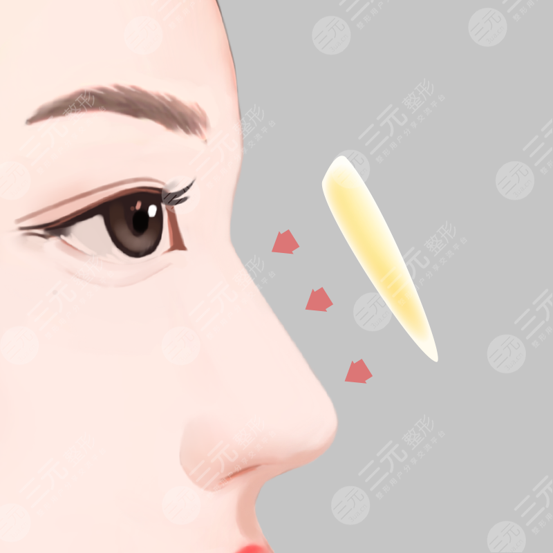 隆鼻术后的各种图片