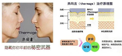 热玛吉做一次多少钱？有3个影响价格的因素！附注意事项~