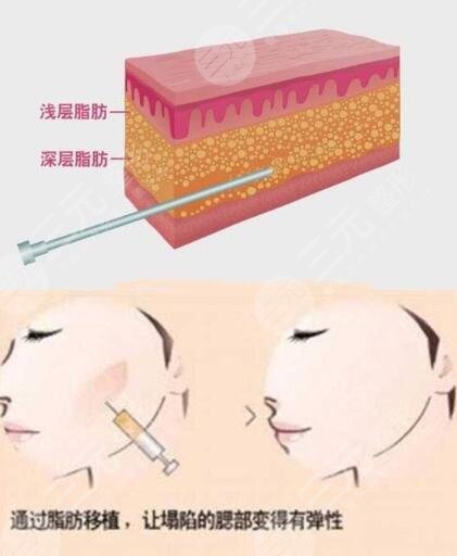 脂肪填充脸部有什么副作用？悄悄变身饱满少女脸~