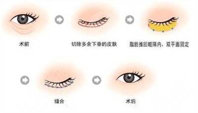 去眼袋手术果对比图