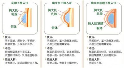 假体丰胸需要多少钱？丰胸前后对比果图