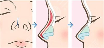 硅胶假体和膨体隆鼻果怎么样?哪个好?多少钱?