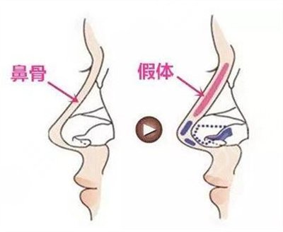 隆鼻整形手术选择自体脂肪还是假体隆鼻好?