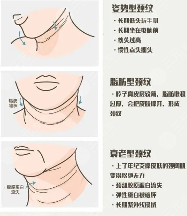 颈纹特别多还深 怎么办