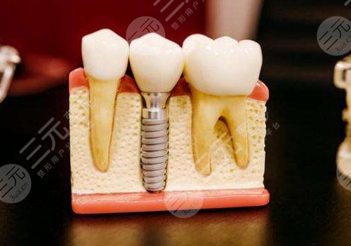 2022全国种植牙价格表种植牙的价格表，品牌、医生、规模影响价格