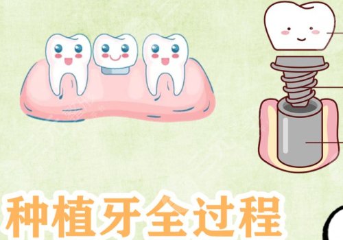 种植牙的原理介绍