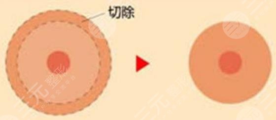 乳晕缩小手术后的护理事项是什么?