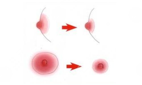 乳晕缩小手术有什么危害？手术费用、优点、术后护理盘点！