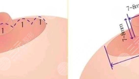 乳晕缩小手术的危害是什么?