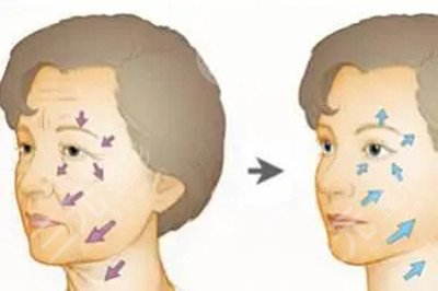 热玛吉案例对比：从术前到术中再到术后的详细记录，30岁变25岁~