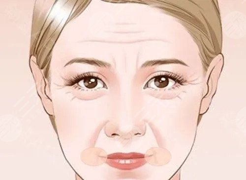 泪沟填充前后对比照片图片过程