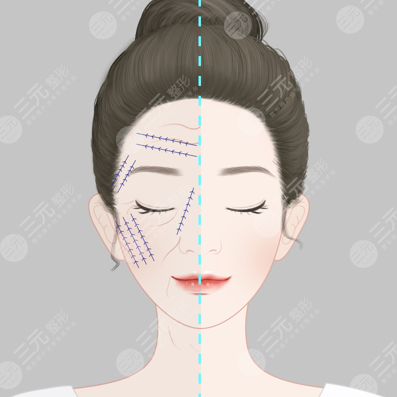 那些注射瘦脸教会我的事:和皱纹一样春风吹又生的,还有渣男