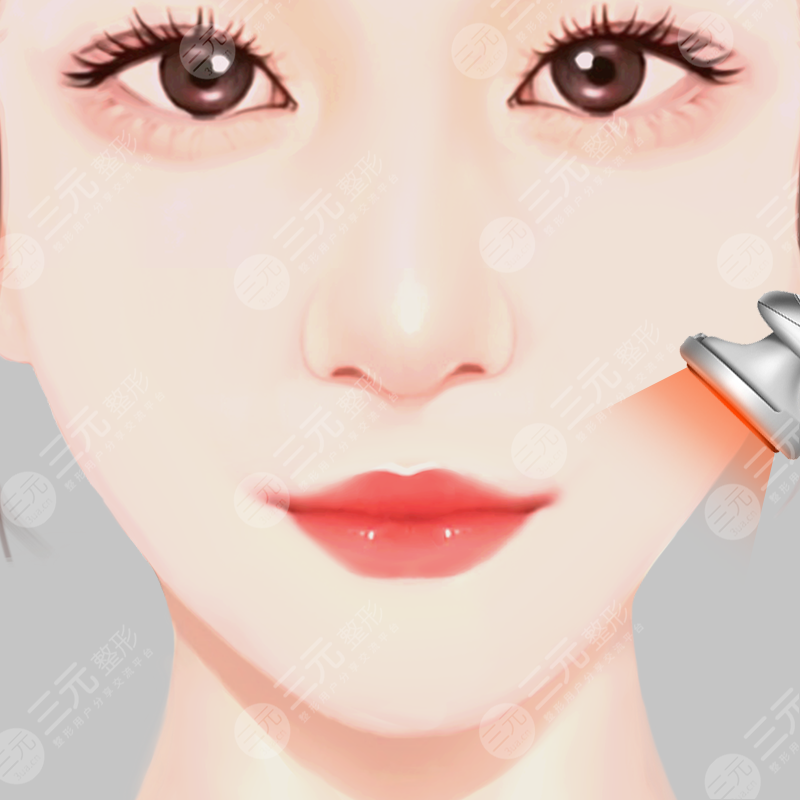 图3 一名39岁女性求美者基线(A)及手术(伴BoNT-A注射)后6个月(B)的鼻部对称性示意图