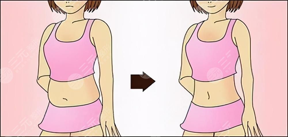 腰腹部抽脂会留疤吗?