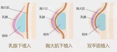假体丰胸降低风险吗？术后注意事项有哪些
