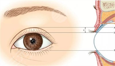 三点定位双眼皮过程和价格医院介绍
