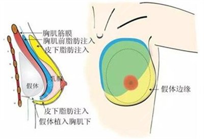 上海做假体隆胸手术需要多少钱？有名专家强烈推荐
