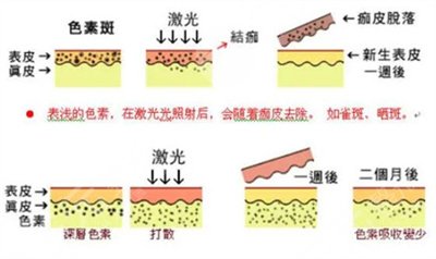光子祛斑的优势