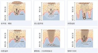 激光祛斑后注意哪些事项