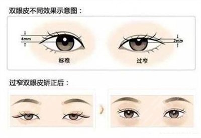 上海中山医院割双眼皮案例