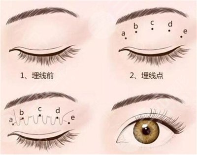 郑州悦美美容医院双眼皮案例欣赏