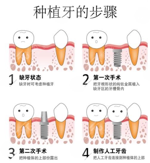 牙齿种植的操作步骤有哪些?