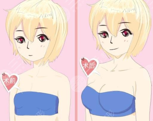 胸假体优势上的差别