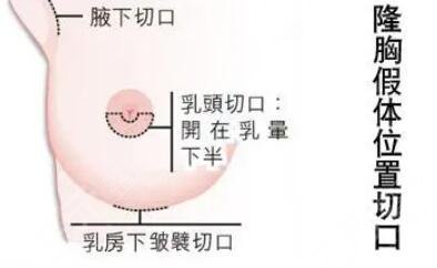 假体隆胸手术适合哪些人呢?