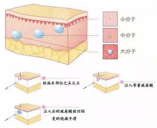 玻尿酸丰唇怎么样?能维持多久? 玻尿酸丰唇怎么样?能维持多久?