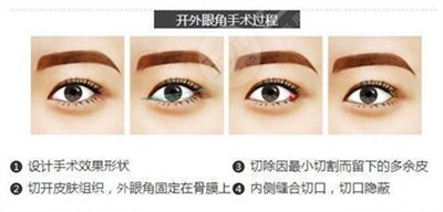 开眼尾和开眼角多少钱